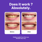 Bryance™ Whitening Strips